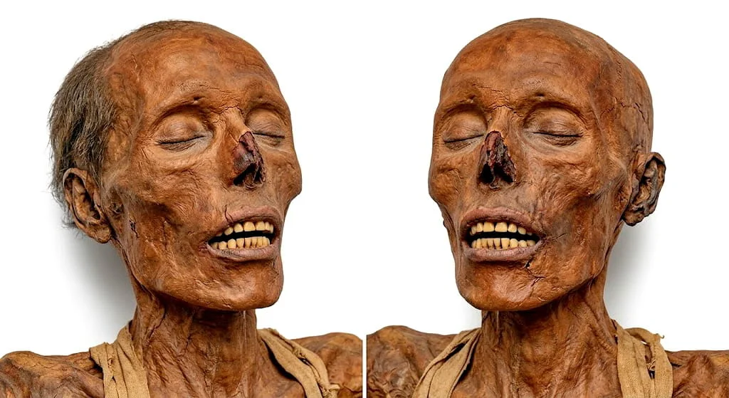 Thutmose II Death, Disease, and the Deir el-Bahari Mummy Cache